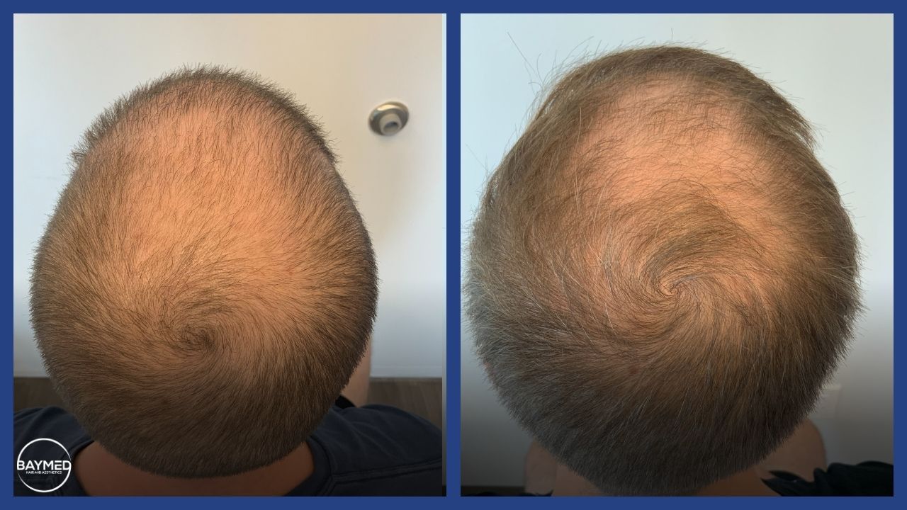 before-and-after-photos-hair-loss1.jpg